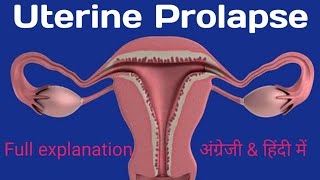 uterine prolapse presentationuterine prolapse symptomsuterine prolapse lecture in Hindiexercise [upl. by Lluj766]