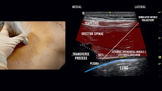 Paravertebral Block  UltrasoundGuided Demonstration [upl. by Seif]