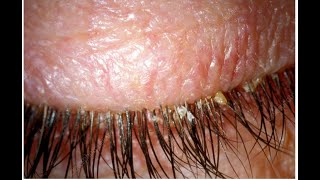 Squamous Blepharitis [upl. by Larrisa]