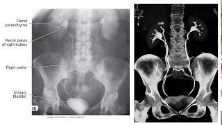 Radiographic Contrast Studies of the Urinary System [upl. by Earahc]