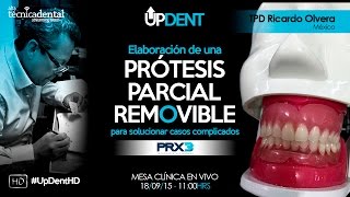 Elaboración de una Prótesis Parcial Removible para solucionar casos complicados [upl. by Jo]