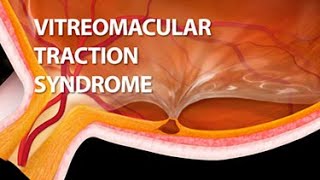 Vitreomacular Traction Syndrome [upl. by Costello]