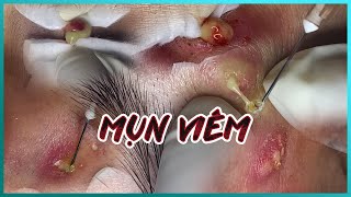 Big Cystic Acne Blackheads Extraction Blackheads amp Milia Whiteheads Removal Pimple Popping [upl. by Nerrag]