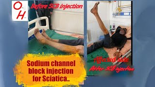 Sodium channel block injection Pain relief from Sciatica in 15 minutes [upl. by Llertnac8]