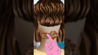 Giant hardened flakes dandruff removal at hairline Scalp Asmr animation asmr shorts short [upl. by Mian360]