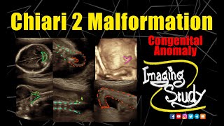 Chiari 2 Malformation  Ultrasound  Anomaly  Case 287 [upl. by Soalokcin625]