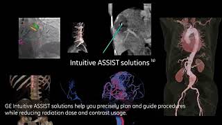 EQUIPAMENTO GE Allia IGS 7 Augment your outcomes hemodinamica radiologia hemodinâmica rx [upl. by Ellyn]