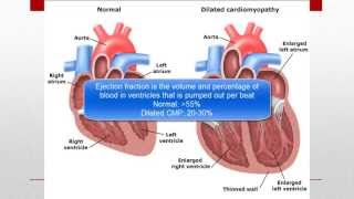 Cardiomyopathy CMP [upl. by Ilajna]