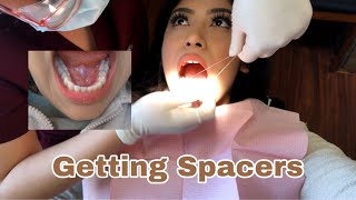 Getting Spacers Before Braces  WHAT TO EXPECT  VLOG 1 [upl. by Minor]