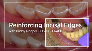 Reinforcing Incisal Edges [upl. by Lugar]