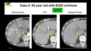 17 LIRADS Casebased Review  Part 1 By Dr Ania Kielar [upl. by Arlyne876]