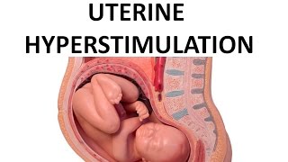 Uterine Hyperstimulation [upl. by Arnaldo]