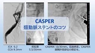 CASPER 頚動脈ステント留置（CAS）のコツ [upl. by Flip]