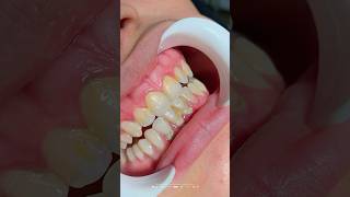 Scaling and Polishing Day😱viralmyaccount🙏🙏😚😘 dentist teethwhitening dentistryworld viralvideos [upl. by Nyladnar]