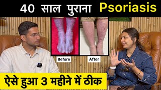 Psoriasis Treatment In Hindi Ft upasanakiduniya  Skin Disease  Himanshu Bhatt [upl. by Lindley783]