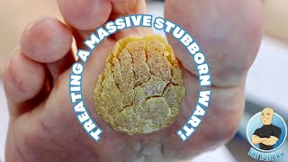 TREATING A MASSIVE STUBBORN WART USING A MICROWAVE [upl. by Erreit]