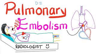 Pulmonary Embolism PE  Causes Symptoms Signs Diagnosis amp Treatment  Respiratory System [upl. by Caralie]