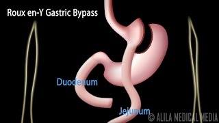 Roux enY Gastric Bypass with Introduction on Body Mass Index Animation [upl. by Hgieleak]