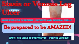 Venous Leg Ulcer Stasis Ulcer  Understanding the cause  treatment and selfmanagement [upl. by Borer]