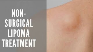 HOW TO DISSOLVE LIPOMA USING FAT DISSOLVING INJECTIONS  INJECTION LIPOLYSIS TECHNIQUE FOR LIPOMA [upl. by Olegna]