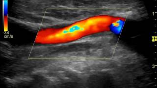 CAROTID DUPLEX CCA TO SUBCLAVIAN ARTERY BYPASS [upl. by Naimerej241]