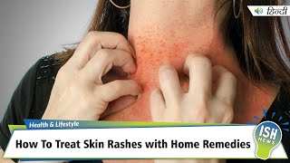 How To Treat Skin Rashes with Home Remedies  ISH News [upl. by Aneehsram]