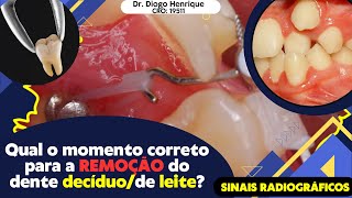 Qual é o momento correto para fazer a exodontia do dente decíduo  aula 66 [upl. by Auberon74]