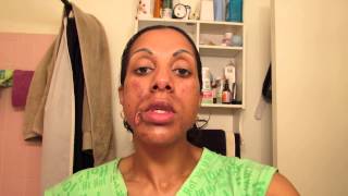 Glycolic Acid and Lactic Acid Chemical Peel Day 2 Part 3 [upl. by Coretta]