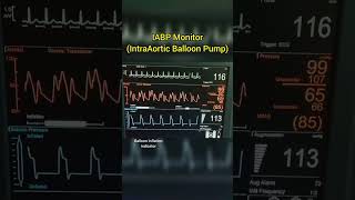 Intra Aortic Balloon Pump IABP cardiology [upl. by Alesram]