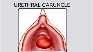 Urethral caruncle DefinitionPathogenesisClinical Features Differential Diagnosis and Treatment [upl. by Cave539]