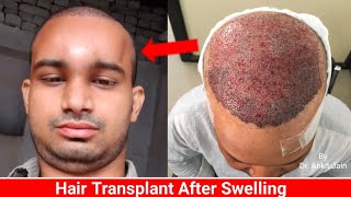 Swelling After Hair Transplant  When it go All about Swelling Best Hair Transplant in INDIA [upl. by Ikaz]