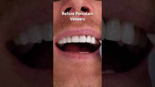 Before Porcelain Veneers dentalrestoration porcelainveneers music remix [upl. by Moyra645]