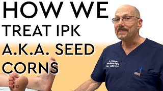 How We Treat IPK  Porokeratosis  Seed Corns [upl. by Nerval446]