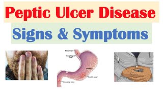 Peptic Ulcer Disease Signs amp Symptoms  Gastric vs Duodenal Ulcers [upl. by Etram]