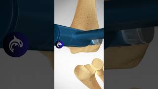 How does an Elbow Replacement work 3D Animation [upl. by Alyal]