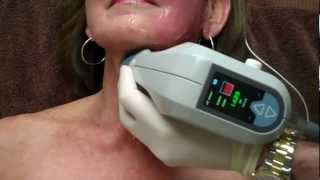 Exilis on Face amp Neck for Skin Tightening with Dr Seiler [upl. by Mclain]