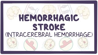 Hemorrhagic stroke intracerebral hemorrhage  causes symptoms diagnosis treatment pathology [upl. by Sheedy]