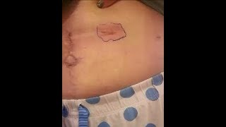 Redness around Incision  Infection or Tape Allergy [upl. by Mccully535]