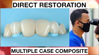 Step by step Layering Anterior Multiple Case Composite  General Dentist Griya RR [upl. by Elladine]