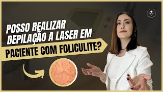 Posso realizar depilação a laser em paciente com foliculite [upl. by Yenot]