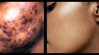 How to Remove Dark amp Black Spots on Face  Get Flawless Glowing Skin  superWOWstyle [upl. by Saihttam739]