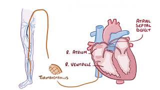 Pulmonary Embolisms causes symptoms diagnosis treatment pathology [upl. by Decker]