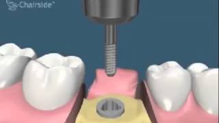 Implant dentaire et couronne dentaire pour remplacer une dent [upl. by Stoddart]