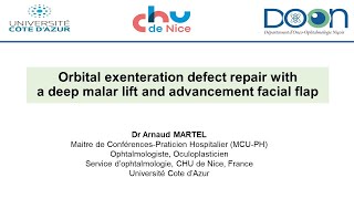 Orbital exenteration defect repair with a deep malar lift and a facial advancement flap [upl. by Tice]