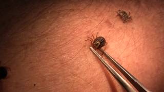 Tick attachment and removal video by B Drees and P Teel [upl. by Hallam]