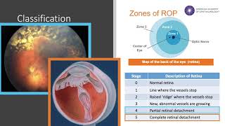 Retinopathy of Prematurity [upl. by Patterson813]