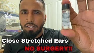 Close Stretched Ears Without Surgery Must Watch [upl. by Aset]