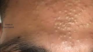 Forehead Acne amp Blackhead Treatment  Blackhead Removal on forehead removeblackhead [upl. by Nnaeilsel179]