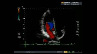 Echocardiogram  Heart ultrasound [upl. by Ahsinak744]