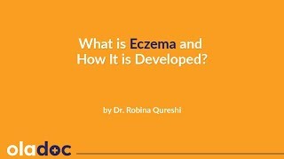 How to Treat Eczema In Urdu Hindi  Eczema Kya Hai  Kharish Ka Ilaj  How Does Eczema Develop [upl. by Abad529]